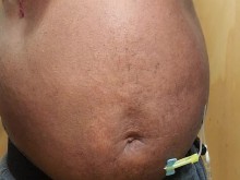 Inflación del vientre con N2O